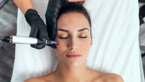 Model of patient receiving microneedling Treatments at Philly Skin and Laser in Philadelphia, PA